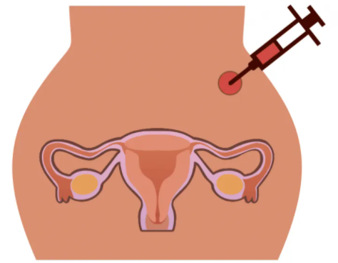 国内代怀的价格,试管婴儿移植后注意事项 分别是这十项